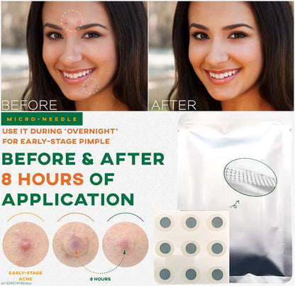 9-Piece Microneedle Acne Patches with Hyaluronic Acid & Salicylic Acid