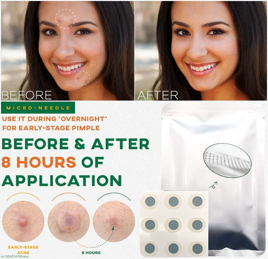 9-Piece Microneedle Acne Patches with Hyaluronic Acid & Salicylic Acid