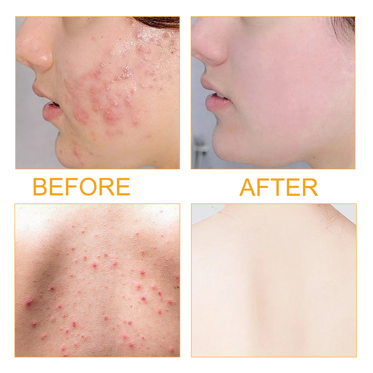 Jayusing Acne Care Body Serum with Collagen Peptides & Jojoba Oil
