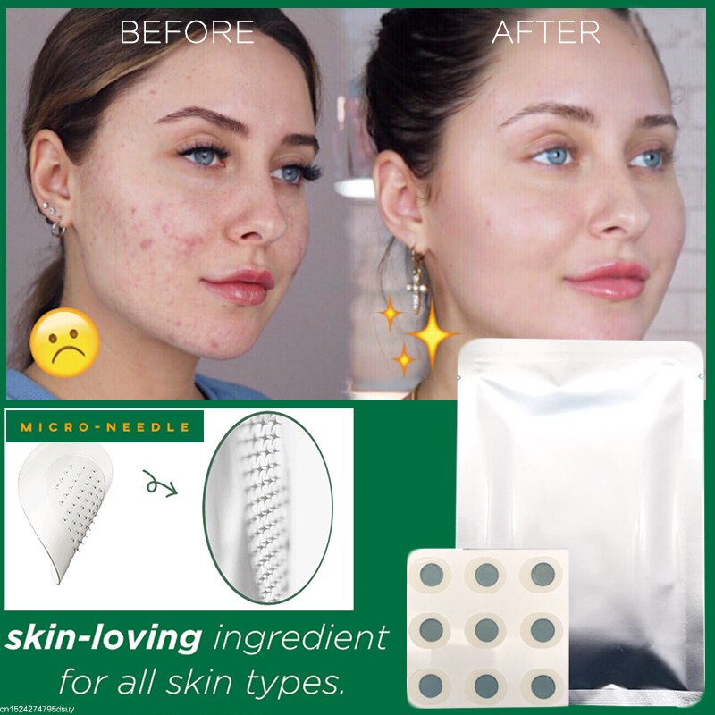 9-Piece Microneedle Acne Patches with Hyaluronic Acid & Salicylic Acid